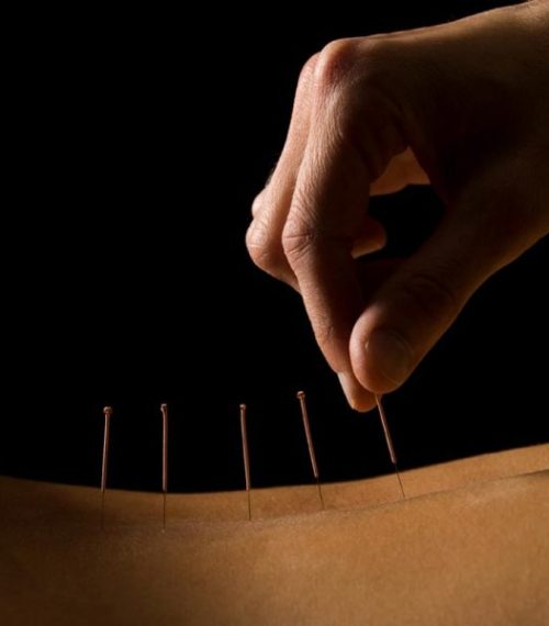 Acupuncture service